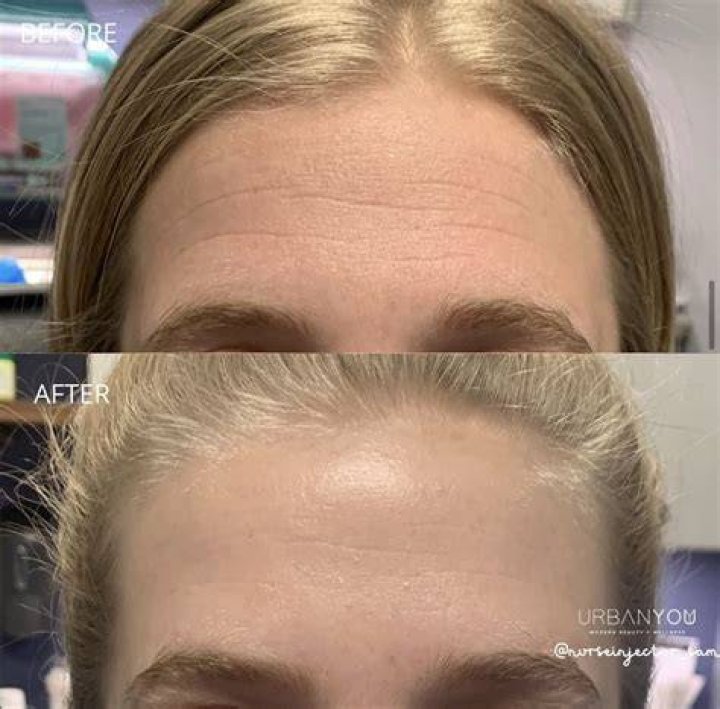 Am I Too Young Botox?