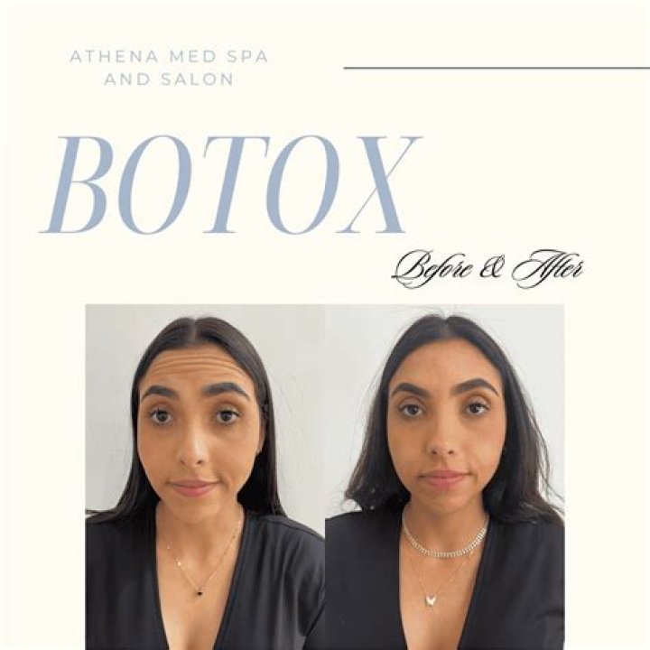 Am I Too Young For Botox?