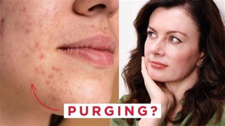 An Expert Explains Skin Purging
