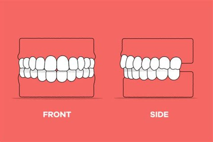 Are Your Teeth Supposed To Touch