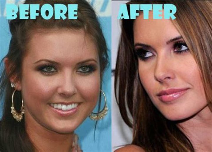 Audrina Patridge Plastic Surgery Audrina Patridge Plastic Surgery