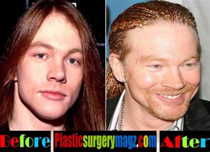 Axl Rose, Plastic Surgery, Before And After Axl Rose Now 1024x759