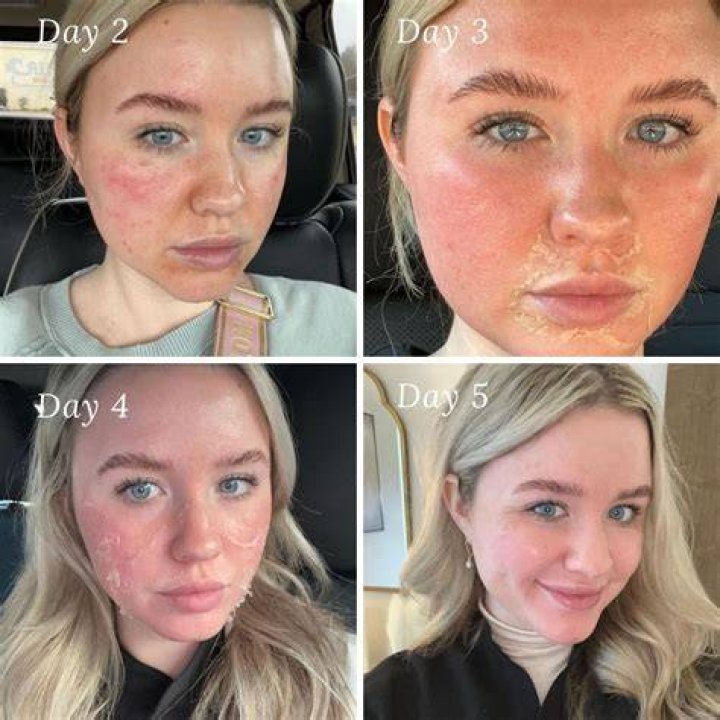 Chemical_Peel