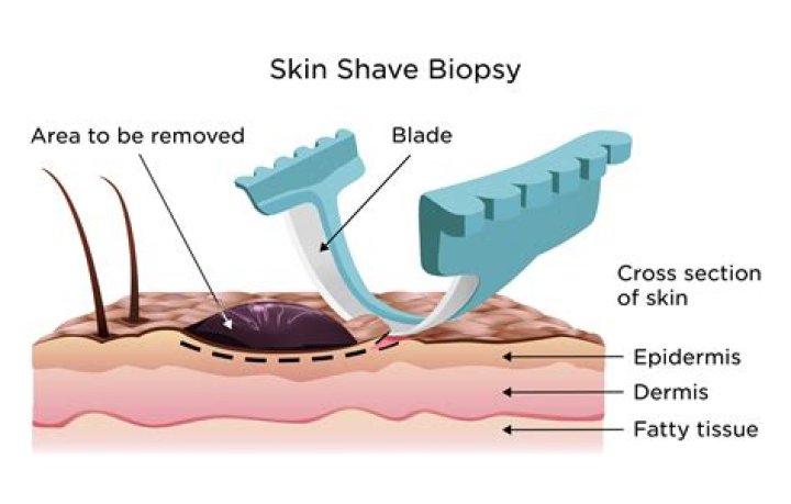 Do Weird Beauty Quick Fixes Work? We Ask a Derm