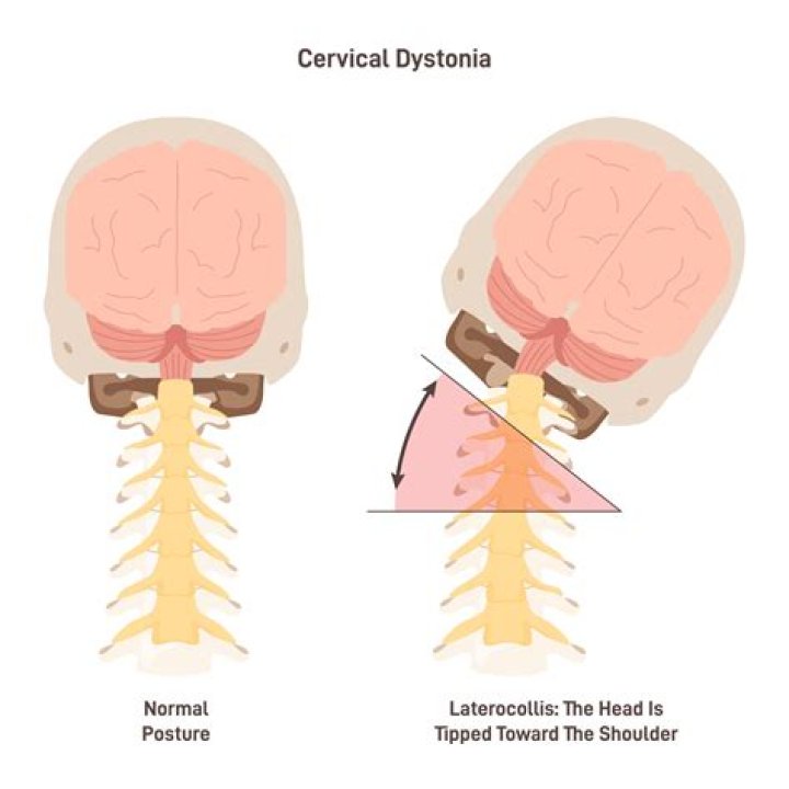 Does Kerry Kennedy Have Spasmodic Dysphonia Too?