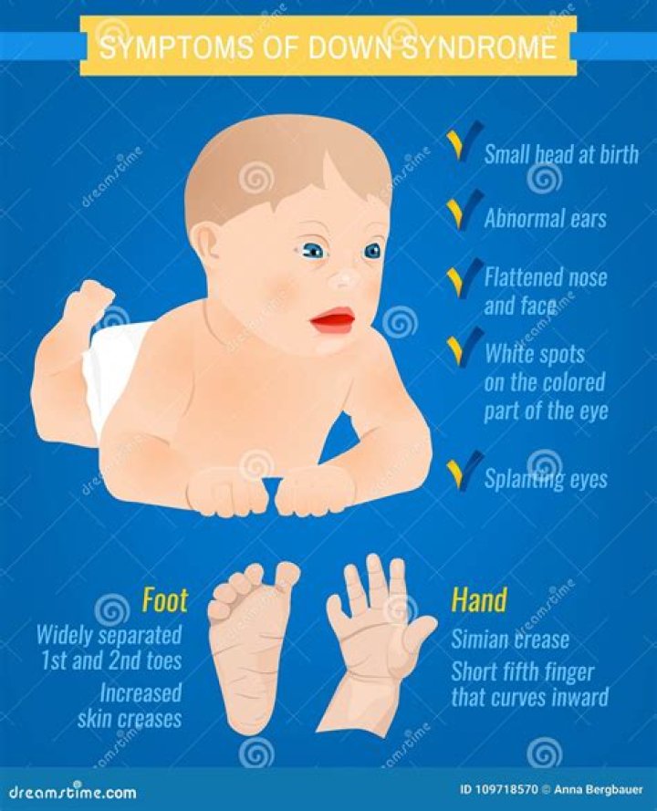 Down Syndrom Symptoms stock vector. Illustration of indication 108274414