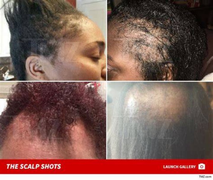 scalp burn from relaxer scalp burn from relaxer