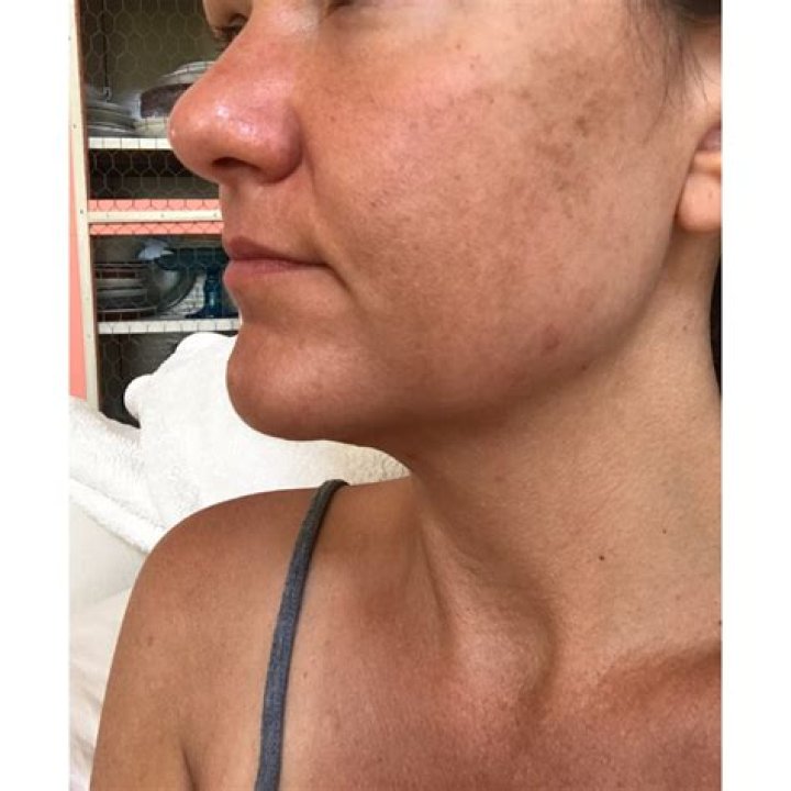 tanning acne