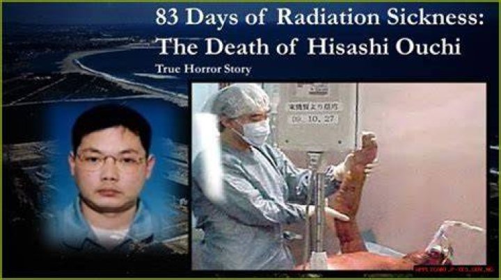 The Tragic Aftermath Hisashi Ouchi's Life After Radiation Exposure